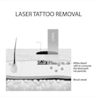 Skin Rejuvenation and Tattoo Removal